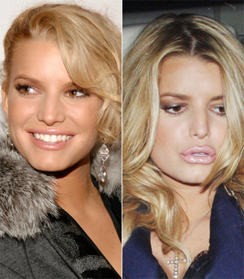 "Phong trào" bơm môi của sao Hollywood - 4