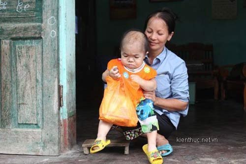 Bệnh lạ: Thiếu nữ 22 tuổi như trẻ lên 3 - 2
