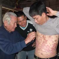 Sức khỏe đời sống - “Khắc tinh“ của bệnh chàm