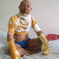 Sức khỏe đời sống - Ăn lẩu: Thực khách bị cồn đốt cháy mặt