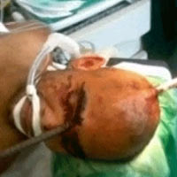 Sức khỏe đời sống - Thanh sắt đâm xuyên đầu: Thoát chết kỳ diệu