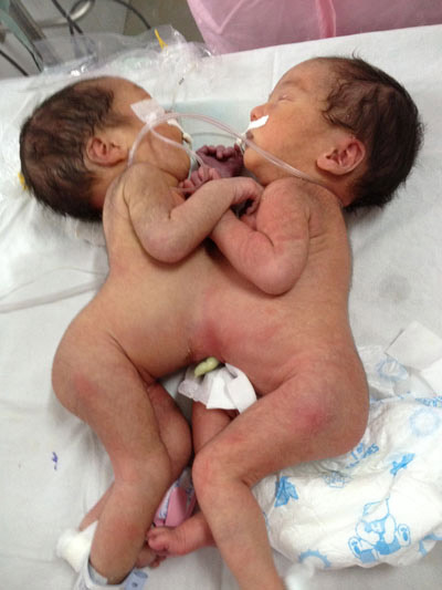 Hai bé gái song sinh dính liền bụng ngực - 1