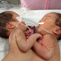 Tin tức trong ngày - Hai bé gái song sinh dính liền bụng ngực