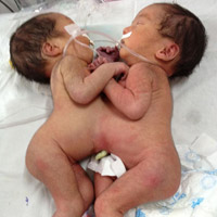 Bệnh trẻ em - Hai bé gái song sinh dính liền bụng ngực