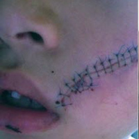 Tin tức trong ngày - TQ: Khâu 38 mũi ở mặt vì lon Pepsi phát nổ