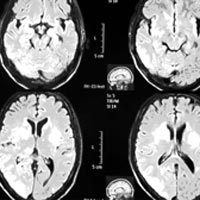 Sức khỏe đời sống - Hà Nội: Phát hiện ca viêm màng não do nấm