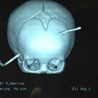 Sức khỏe đời sống - Cứu sống trẻ bị thanh sắt xuyên qua đầu