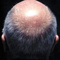 Sức khỏe đời sống - Vitamin D có thể giúp chữa hói