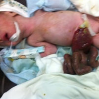 Sức khỏe đời sống - Cứu sống bé sơ sinh có ruột, gan nằm ngoài ổ bụng