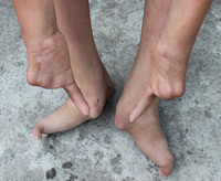 Kỳ lạ gia đình tứ chi 1 ngón