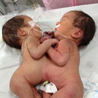 Sức khỏe đời sống - Thêm cặp song sinh dính liền