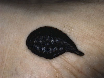 Phương pháp chữa bệnh ghê rợn nhất lịch sử - 2