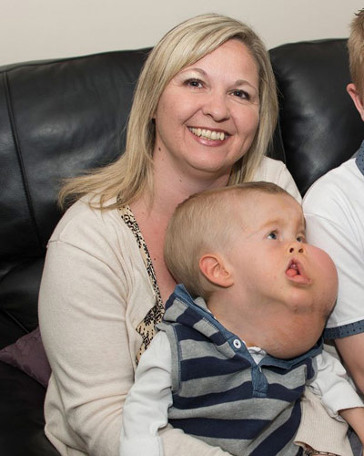 Bé 2 tuổi mắc bệnh bí ẩn mặt to hơn thân - 2