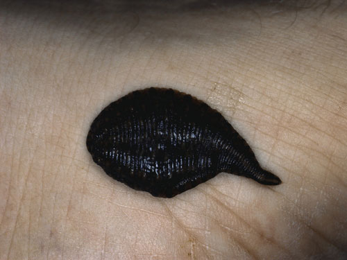 Những phương pháp chữa bệnh rợn nhất lịch sử - 2