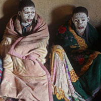 Sức khỏe đời sống - 10 người mất "của quý" sau khi cắt bao quy đầu