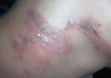 Cách điều trị chứng “giời leo” - 2