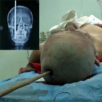 Phi thường - kỳ quặc - Thanh thép gần nửa mét cắm vào đầu