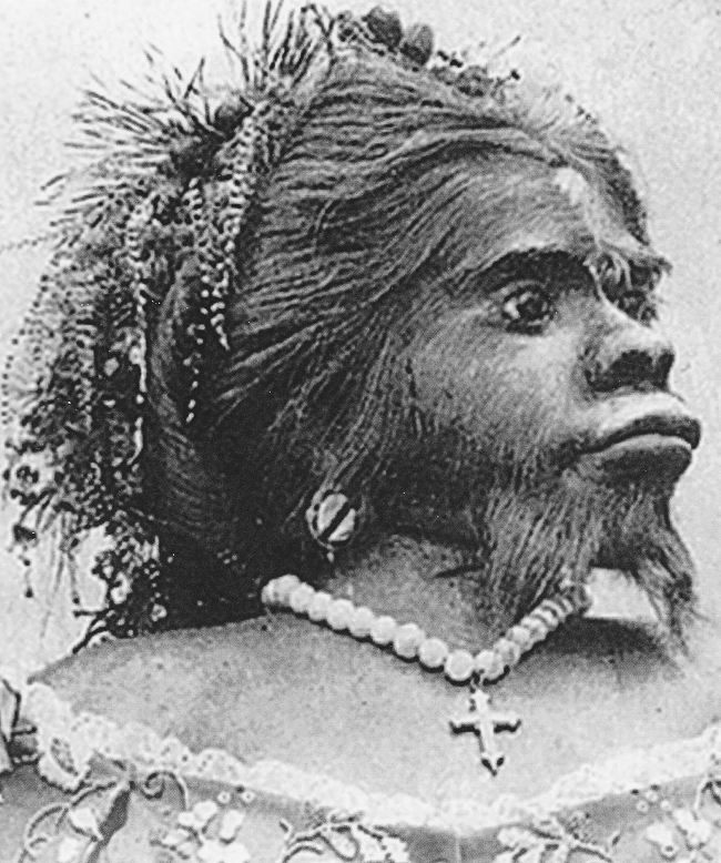 Julia Pastrana (1834 – 25/3/1860) là phụ nữ Mexico sinh ra đã mắc chứng rậm lông. Pastrana có tai và nũi rộng khác thường và hàm răng không bình thường.