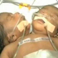 Sức khỏe đời sống - Bé trai 2 đầu chào đời tại Ấn Độ