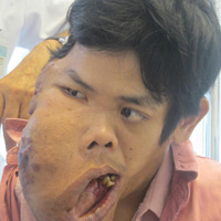 Tin tức trong ngày - Người đàn ông hơn 30 năm mang "khuôn mặt quỷ”