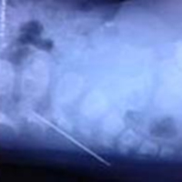 Sức khỏe đời sống - Kim đâm ngập vùng xương cụt bé trai 18 tháng tuổi