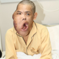 Sức khỏe đời sống - Người hơn 30 năm mang "mặt quỷ" được phẫu thuật