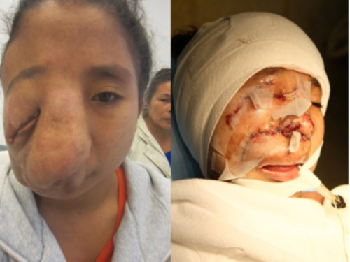 Khuôn mặt mới của "dị nhân” sau bóc tách khối u - 1