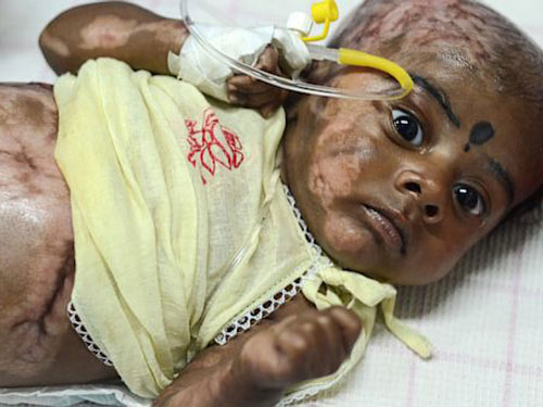 Đứa trẻ tự bốc cháy bí ẩn tại Ấn Độ - 1