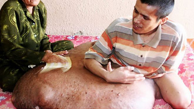 Anh Nguyễn Duy Hải, bị khối U ở chân nặng tới 176 pound (khoảng 85 kg)