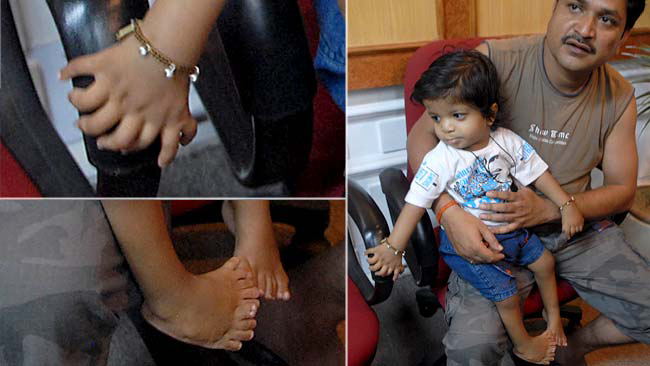 Bé Akshat Saxena, sinh ra ở Ấn Độ, người có nhiều ngón tay chân nhất thế giới, 34 ngón.