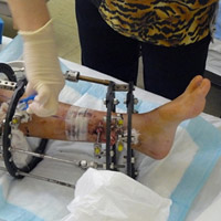 Sức khỏe đời sống - Phá nốt ruồi bằng a-xít: Rước họa vào thân