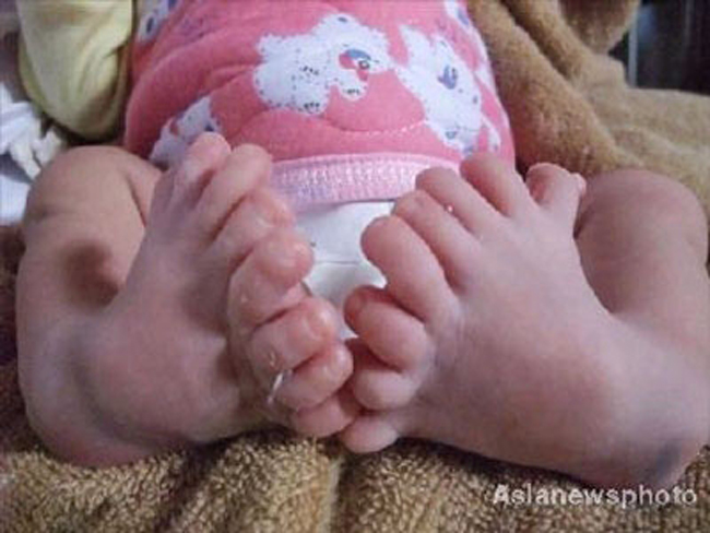 Một em bé ở Quảng Đông, Trung Quốc được sinh ra vào ngày 5/11/2008 với mỗi bàn chân có tới 8 ngón .