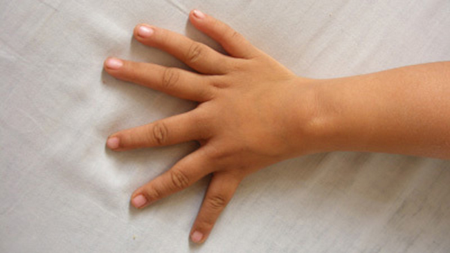 Bé Xiao Qian, 4 tuổi, ở Vũ Hán, tỉnh Hồ Bắc bị dị tật bàn tay với 6 ngón trông gần như nhau và không có ngón cái.