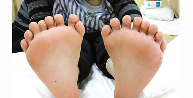 Một cậu bé 6 tuổi từ thành phố Cáp Nhĩ Tân, Trung Quốc có 15 ngón tay 