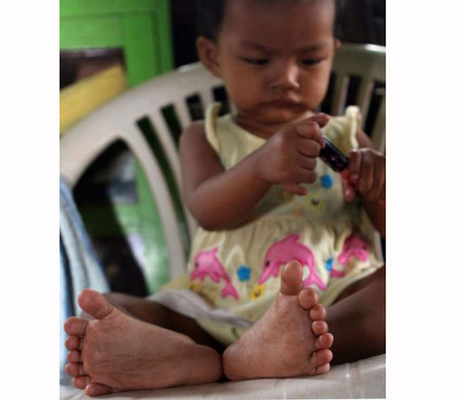 Lei Yadi Min, bé gái Trung Quốc có tổng số 26 ngón tay, chân