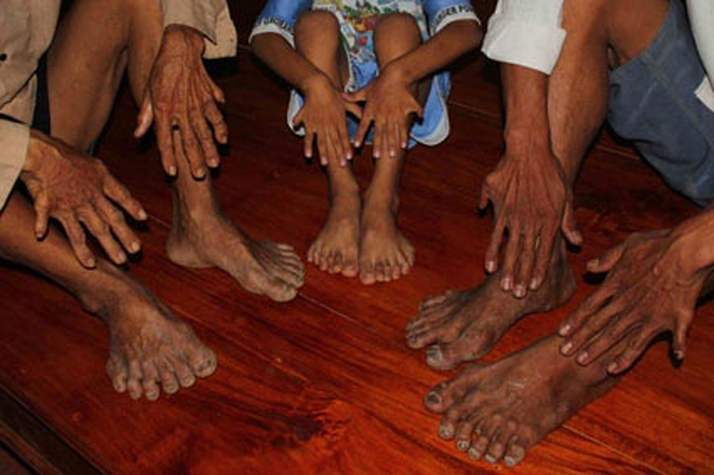 Gia tộc của ông Võ Văn Cống - ở huyện Chợ Lách, tỉnh Bến Tre: gia tộc nhiều người có 24 ngón chân, tay