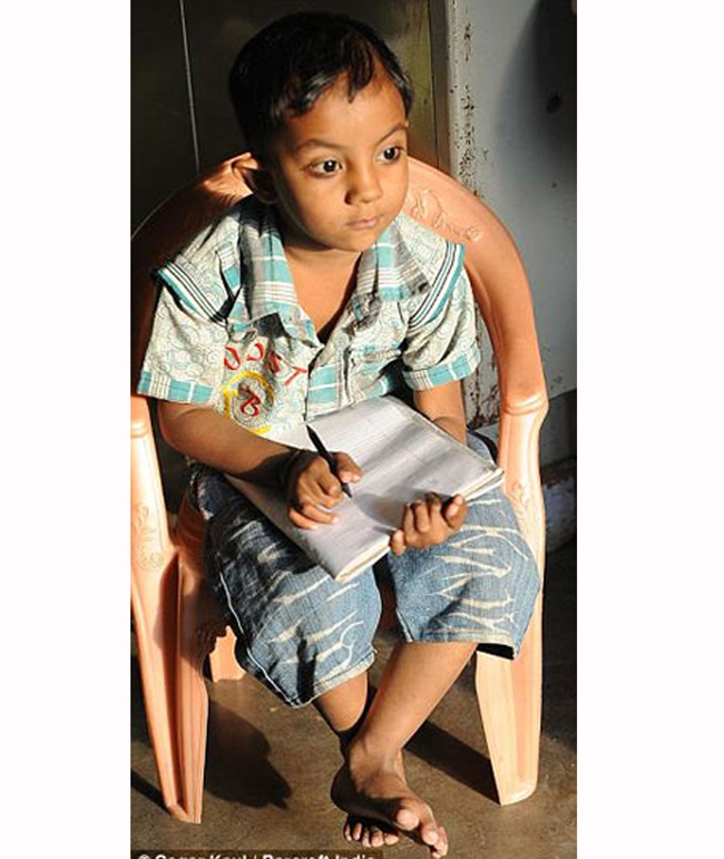 Arpan Saxena, đang sống tại Bhopal (Ấn Độ), có tất cả 13 ngón tay và 12 ngón chân.