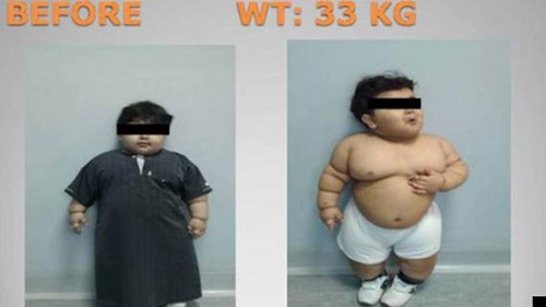 Phẫu thuật cho bé 2 tuổi nặng 33kg - 1