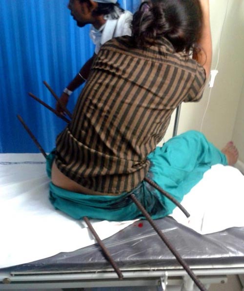 Thiếu nữ bị 3 thanh sắt đâm xuyên người - 1