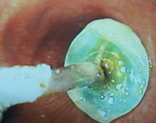 Rùng mình nghe bác sĩ kể chuyện gắp dao lam từ thực quản - 2