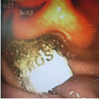 Sức khỏe đời sống - Rùng mình nghe bác sĩ kể chuyện gắp dao lam từ thực quản