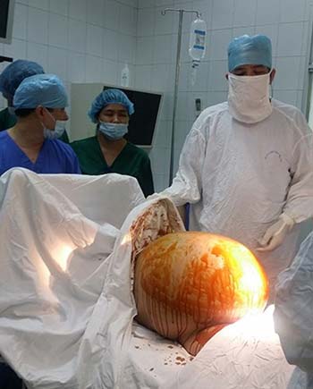 Con dâu mang khối u khủng 23kg: Mẹ chồng hụt hẫng - 1