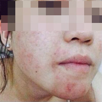 Làm đẹp - Hỏng da vì "mê" sữa non kích trắng giá rẻ