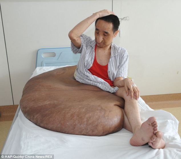 Cắt bỏ khối u 110 kg cho người đàn ông Trung Quốc - 1