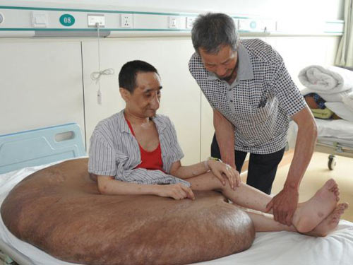 Người đàn ông mang khối u lớn nhất thế giới: 110 kg - 1