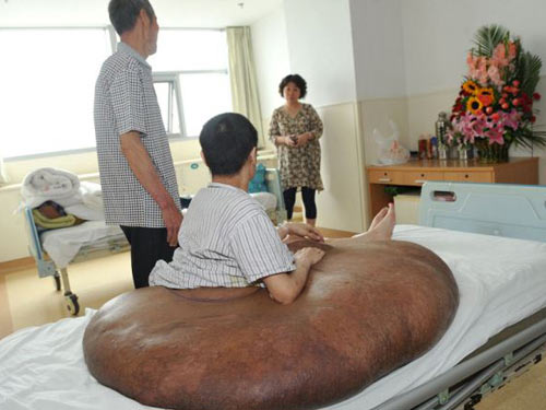 Người đàn ông mang khối u lớn nhất thế giới: 110 kg - 2