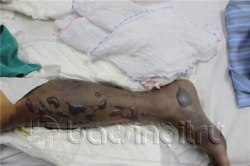 Vết thương gặp nước bẩn, hàng loạt người tử vong - 1