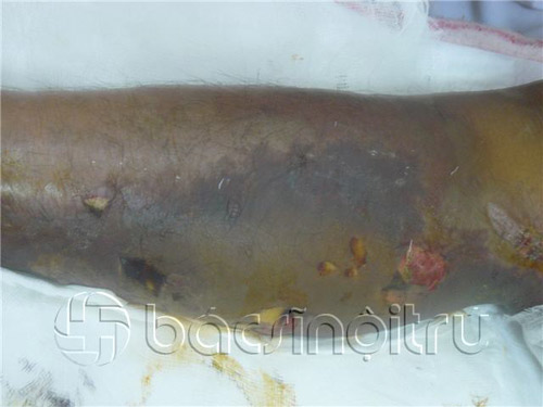 Vết thương gặp nước bẩn, hàng loạt người tử vong - 2