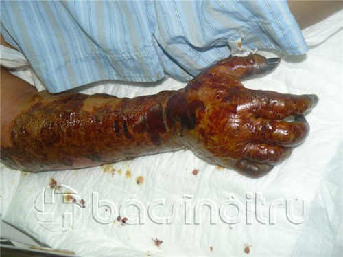 Vết thương gặp nước bẩn, hàng loạt người tử vong - 3