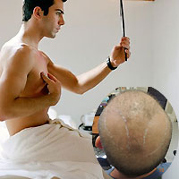 Bí quyết làm đẹp - Lạ lùng chuyện cấy lông ngực lên đầu chữa hói